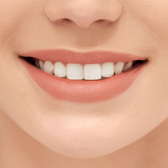 Kit per sbiancamento denti 